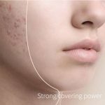 Acne-prone skin before makeup application