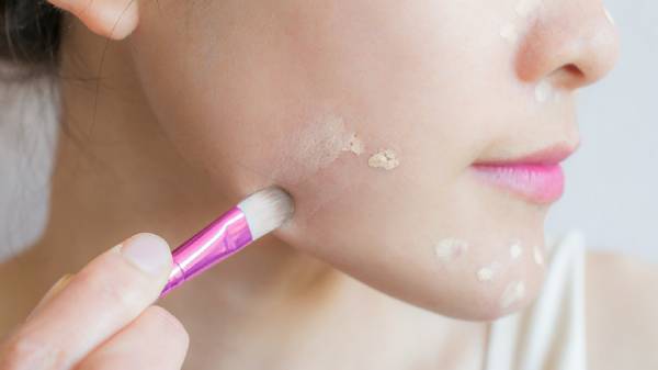Pinpoint concealing technique for acne