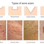 Different types of acne scars