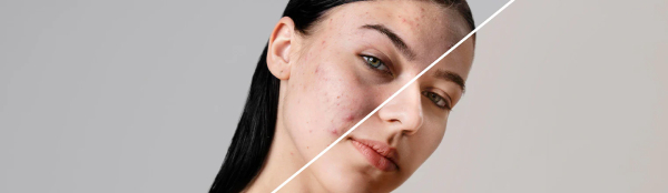 Healthy vs damaged skin barrier